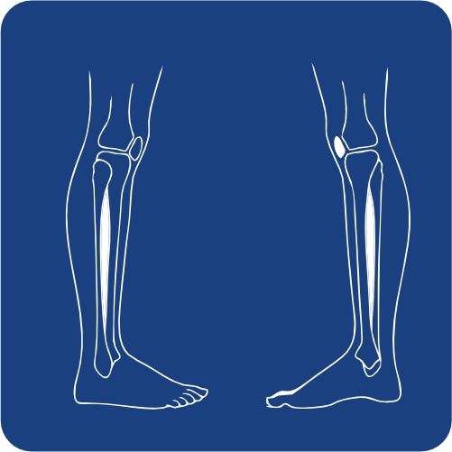 RX TIBIA Y PERONE